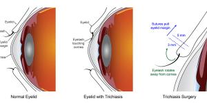 On a normal eyelid (left), eyelashes are turned outward away from the cornea. Eyelids affected by trichiasis (center) have eyelashes touching the eye. Surgery for eyelids affected by trichiasis (right), rotates the eyelash away from the cornea, returning them to their normal anatomic position.